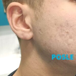 akne-tretman-laserom-posle-poliklinika-diva