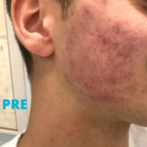 akne-tretman-laserom-pre-poliklinika-diva