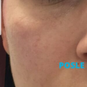 hijaluron-za-korekciju-podocnjaka-iskustva-poliklinika-diva-posle