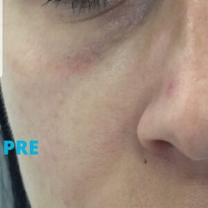 hijaluron-za-korekciju-podocnjaka-iskustva-poliklinika-diva-pre