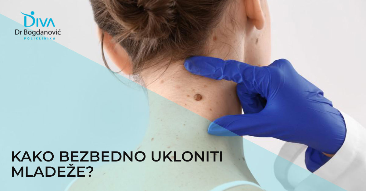 kako-bezbedno-otkloniti-mladeze-poliklinika-diva-dr-bogdanovic