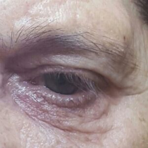 zatezanje-kapaka-pre-procedure-poliklinika-diva