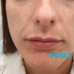 korekcija-podocnjaka-posle-poliklinika-diva-dr-bogdanovic