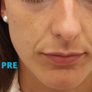 korekcija-podocnjaka-pre-poliklinika-diva