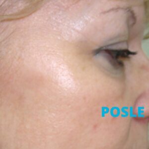 lasersko-skidanje-keratoza-poliklinika-diva-dr-bogdanovic-pre-procedure