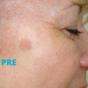 lasersko-skidanje-keratoza-poliklinika-diva-dr-bogdanovic-pre-procedure