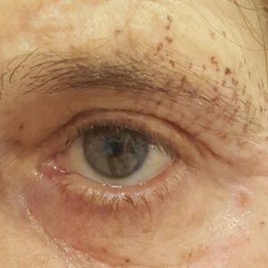 podizanje-kapaka-peti-dan-posle-procedure-poliklinika-diva