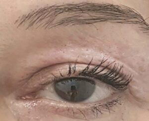 kapci-posle-procedure-poliklinika-diva-dr-bogdanovic