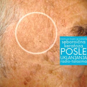 mesto-na-kojem-se-nalazila-seboroicna-keratoza-posle-uklanjanja-radiotalasnom-metodom