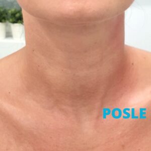 podmladjivanje-vrata-posle-poliklinika-diva