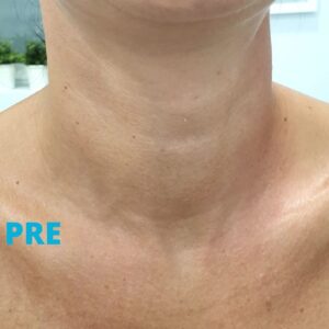 podmladjivanje-vrata-pre-poliklinika-diva