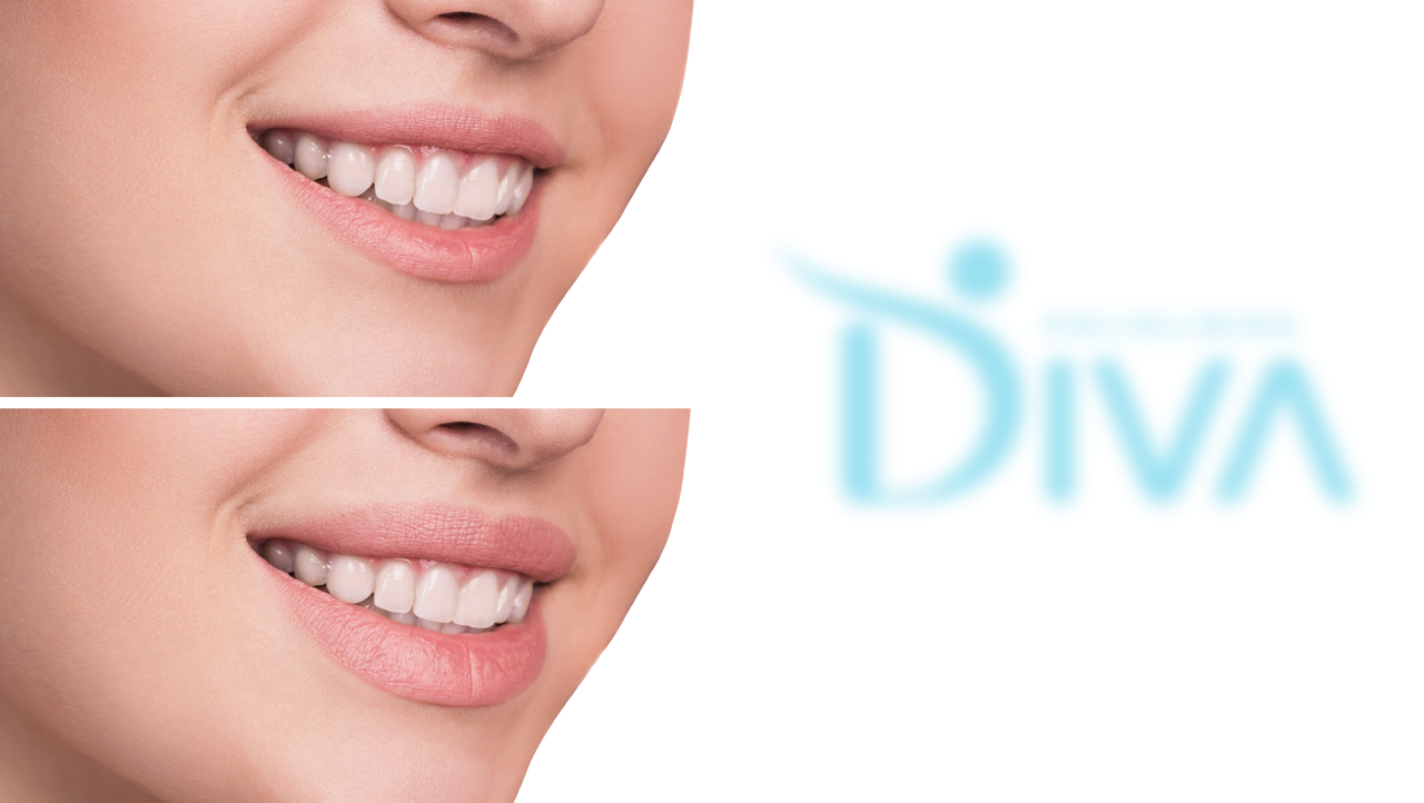 popunjavanje-usana-hijaluronom-diva-poliklinika