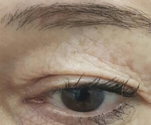 kapci-pre-procedure-poliklinika-diva