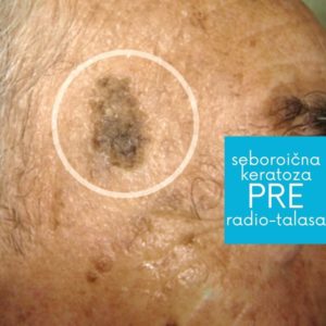 seboroicna-keratoza-pre-uklanjanja-radiotalasnom-metodom