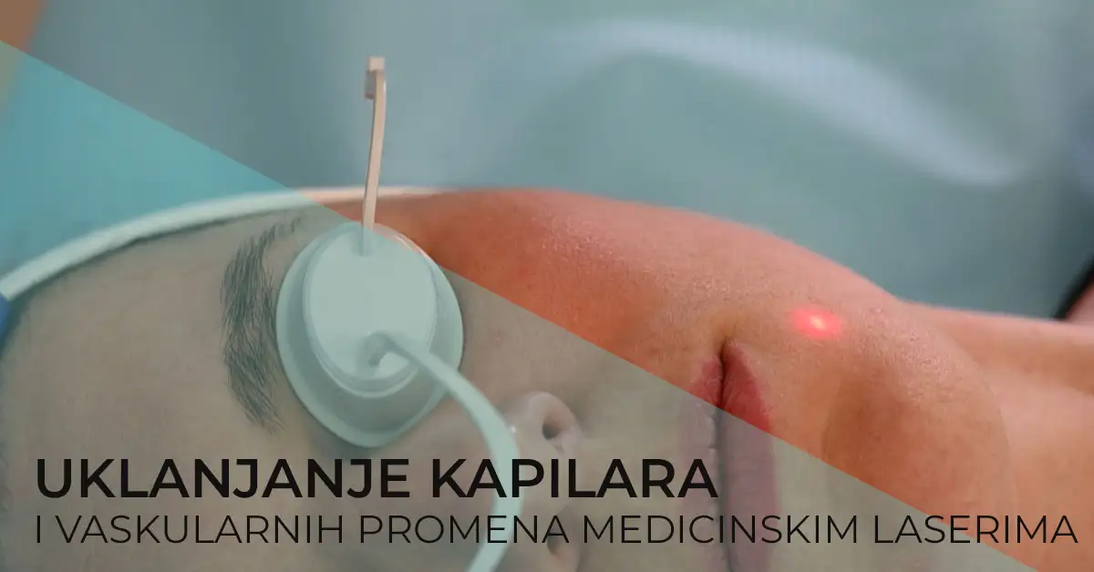 uklanjanje-kapilara-vaskularnih-promena-na-licu-i-dekolteu-diva-poliklinika
