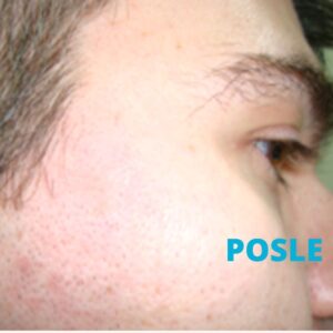 uklanjanje-keratoza-laserom-poliklinika-diva-dr-bogdanovic-posle-procedure