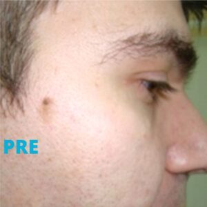 uklanjanje-keratoza-laserom-poliklinika-diva-dr-bogdanovic-pre-procedure