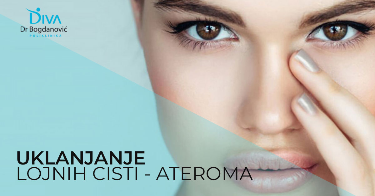 uklanjanje-lojne-ciste-ateroma-radiotalasnom-metodom-poliklinika-diva-dr-bogdanovic