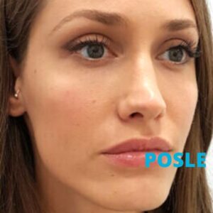 uklanjanje-podocnjaka-hijaluronom-posle-poliklinika-diva-dr-bogdanovic