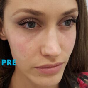 uklanjanje-podocnjaka-hijaluronom-pre-poliklinika-diva-dr-bogdanovic