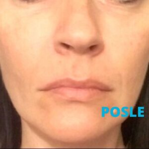 4d-combo-laser-iskustva-posle-poliklinika-diva-dr-bogdanovic