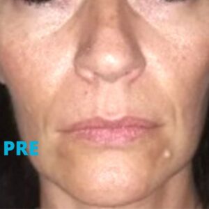 4d-combo-laser-iskustva-pre-poliklinika-diva-dr-bogdanovic