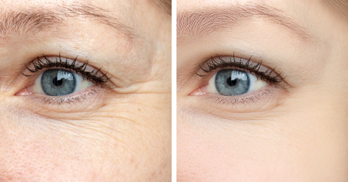 biorevitalizacija-lica-iskustva-poliklinika-diva-dr-bogdanovic