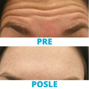 botoks-za-uklanjanje-bora-sa-cela-iskustva-pre-i-posle-poliklinika-diva