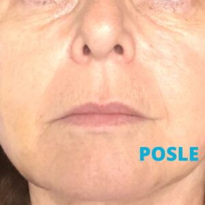 cog-niti-lifting-iskustva-posle-poliklinika-diva