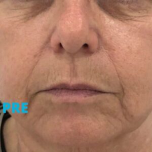 cog-niti-lifting-iskustva-pre-poliklinika-diva