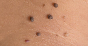 fibromi-poliklinika-diva-dr-bogdanovic-beograd