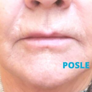 fractora-iskustva-poliklinika-diva-posle