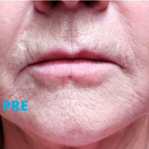 Pre tretmana Fractorom za uklanjanje pušačkih bora u poliklinici Diva