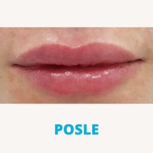 hijaluron-povecanje-usana-poliklinika-diva-dr-bogdanovic-posle