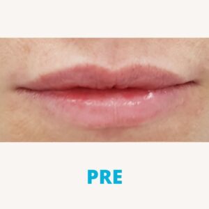 hijaluron-povecanje-usana-poliklinika-diva-dr-bogdanovic-pre