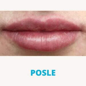 hijaluron-usne-iskustva-posle-poliklinika-diva