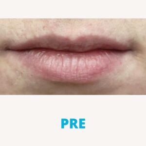 hijaluron-usne-iskustva-pre-poliklinika-diva