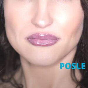 hijaluron-usne-poliklinika-diva-dr-bogdanovic-posle