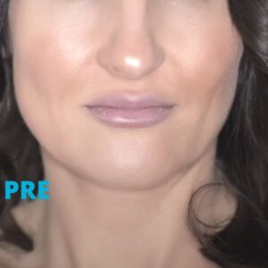 hijaluron-usne-poliklinika-diva-dr-bogdanovic-pre