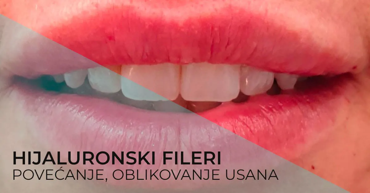 hijaluron-usne-povecanje-usana-hijaluronom-hijaluronski-fileri-za-lepe-usne-poliklinika-diva-dr-bogdanovic