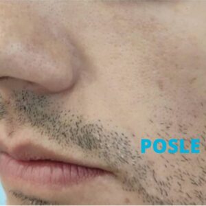 hijaluron-za-muskarce-iskustva-posle-poliklinika-diva