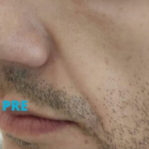 hijaluron-za-muskarce-iskustva-pre-poliklinika-diva