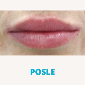 hijaluron-za-usne-iskustva-posle-poliklinika-diva