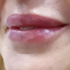 hijaluron-za-usne-poliklinika-diva-beograd