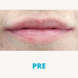 hijaluron-za-usne-poliklinika-diva-dr-bogdanovic-pre