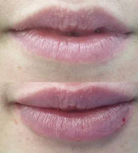 hijaluron-za-usne-rezultat-posle-procedure-poliklinika-diva