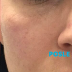 hijaluronski-fileri-iskustva-posle-poliklinika-diva