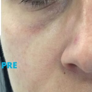 hijaluronski-fileri-iskustva-pre-poliklinika-diva