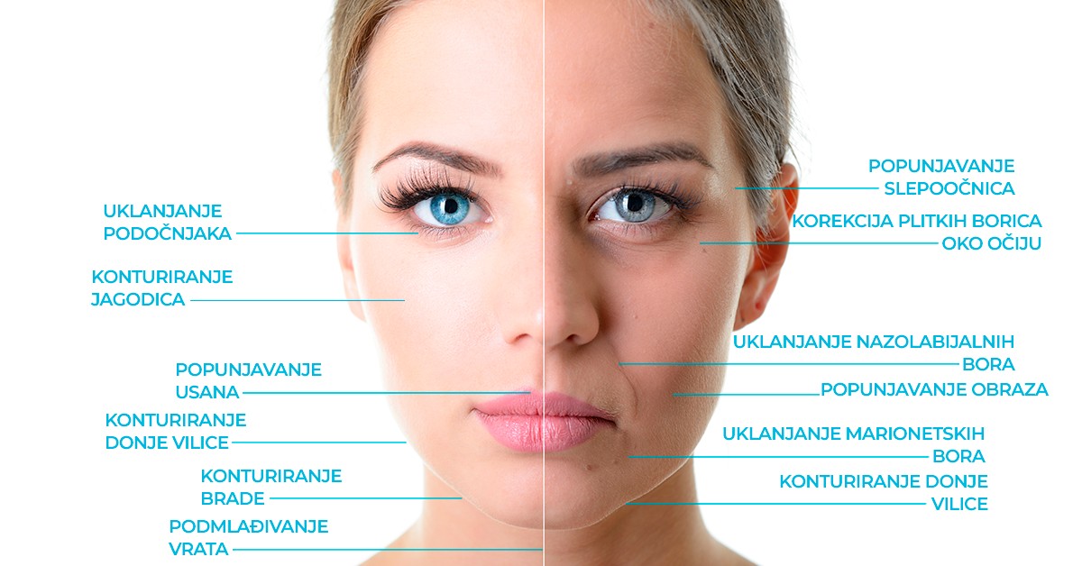 hijaluronski-fileri-primena-poliklinika-diva-beograd