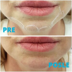 korekcija-brade-hijaluronom-poliklinika-diva